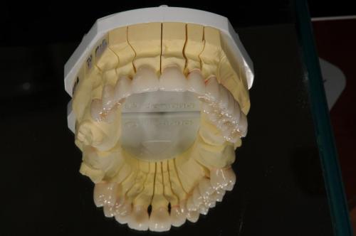 Model vrchnej čeľuste s osadenými protetickými zubami.